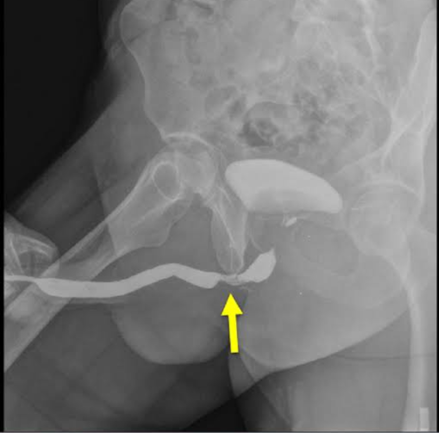 Urethral Stricture Treatment in Nashik | Expert Urologist
