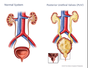 Urinary Tract Obstruction-Dr. Sanket Chaudhari