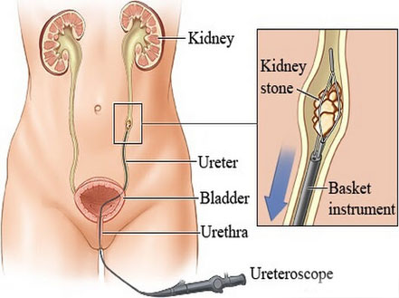 ureteroscopy